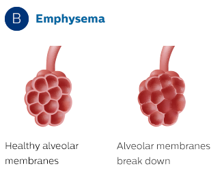 Alveolarmembranen